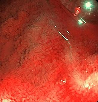 Рельеф слизистой оболочки подвздошной кишки (NBI, близкий фокус). Атлас эндоскопических изображений endoatlas